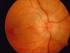 Protocolo de evaluación de la neuropatía óptica glaucomatosa