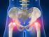 Complicaciones de la cirugía sustitutiva de la cadera en los pacientes con osteopetrosis.