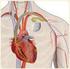 Terapia de resincronización cardíaca (TRC)