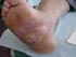 Prevalencia de lesiones en pies de pacientes con Diabetes mellitus tipo 2. Prevalence of foot lesions in patients with Type 2 diabetes mellitus