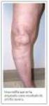 Planificación de artroplastía total de rodilla