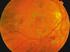 Detección automática de vasos en retinografías