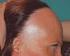 Alopecia frontal fibrosante en pacientes varones