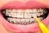 Estado del esmalte dental después de retirar brackets y pulir el adhesivo residual a través de tres mecanismos, en premolares extraídos