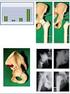 Complicaciones no infecciosas de las artroplastias de rodilla