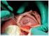 Cirugía fetal (II). Malformaciones fetales susceptibles de recibir tratamiento quirúrgico prenatal
