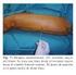 Bloqueo posterior del plexo lumbar para analgesia postoperatoria de artroplastias de cadera