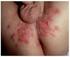 Ulceras Genitales. -Tratamiento para Herpes -Eduque- Consejeria sobre reduccion del riesgo