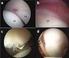 Lesiones del labrum acetabular. Etiología, lesiones artroscópicas e indicaciones de tratamiento.