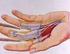 Reparación primaria de los tendones flexores de la mano en la zona crítica