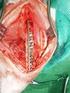 Tratamiento quirúrgico de las fracturas de columna cervical superior