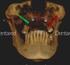 implantes cigomáticos: una solución predecible en paciente con reabsorción maxilar severa