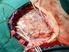 Resultado del tratamiento de la hemorragia subaracnoidea debida a rotura de aneurismas cerebrales