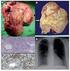 Tumor fibroso solitario de la pleura Aspectos clínico-patológicos