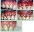 Injertos de tejido blando en cirugía periodontal plástica y estética