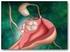 Embolización arterial de miomas uterinos