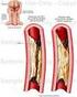 Enfermedad de la arteria carótida común bilateral en la arteritis de Takayasu