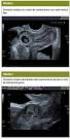 Visualización de embarazo ectópico en resonancia magnética: presentación de dos casos