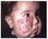 Hemangioma cutáneo gigante en extremidad inferior fetal con diagnóstico ecográfico prenatal: reporte de un caso