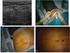 Localización prequirúrgica de lesiones mamarias no palpables: compresor fenestrado versus estereotaxia