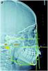 Estudio Morfométrico de la Posición Cráneo-Cervical en Pacientes con Clases Esqueletales II y III