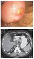 Tomografía computada en las lesiones inflamatorias del colon