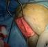 Osteotomía tibial proximal con cuña abierta utilizando el sistema de placas ContourLock Técnica Quirúrgica