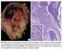 Variante plasmocitoide del carcinoma urotelial: a propósito de un caso Plasmacytoid variant of urothelial carcinoma: a case report