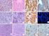 Caracterización inmunohistoquímica de los tumores hepáticos. Una aproximación práctica al diagnóstico del hepatocarcinoma
