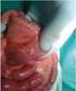 Tumor neuroendocrino metastásico asintomático en ovario en paciente con cáncer de cérvix. Caso clínico.