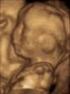 El papel del ultrasonido fetal en el diagnóstico de las malformaciones urinarias congénitas, el nuevo reto para el urólogo. Presentación de un caso