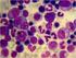 Neoplasia blástica plasmocitoide de células dendríticas