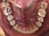 Alternativa de tratamiento para la distalización de molares superiores con una barra traspalatina anclada a un mini-implante