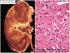 Carcinoma renal metastásico de localización atípica. Revisión de la literatura