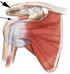 Key Word Shoulder Impingement, Rotator cuff, partial thickness tears.
