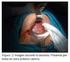 Acretismo placentario con placenta previa. Reporte de un caso