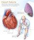 Fisiopatología de la insuficiencia cardíaca