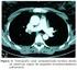 Agenesia de vena cava inferior, trombosis venosa profunda y trombo embolismo pulmonar. A propósito de un caso
