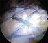 Reparación Artroscópica del Manguito Rotador en pacientes de 70 años de edad o mayores