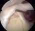 Variantes Anatómicas del Hombro: Parte I Eficacia de la Artro-Resonancia para el Diagnóstico de las Variantes Anatómicas del Labrum Glenoideo