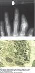 Diagnóstico Diferencial de las Poliartralgias Cuándo sospechar una Artritis Reumatoidea?