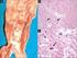 Paraplejía aguda y trombosis segmentaria de aorta infrarrenal