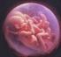 Complicaciones del embarazo gemelar C A P Í TU L O 18 OBSTETRICIA