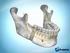 Osteotomía sagital de rama mandibular en cirugía ortognática