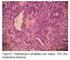 Incidencia de adenocarcinoma de endometrio en la pieza de histerectomía tras diagnóstico de hiperplasia endometrial atípica