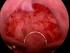 Resultados de la resección histeroscópica de endometrio