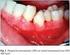 Papel de los herpes virus en la enfermedad periodontal. Revisión de literatura