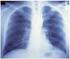 Procedimientos diagnósticos en la fibrosis pulmonar idiopática. Aspectos anatomopatológicos