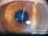 Deterioro en el pronóstico del trasplante corneal por glaucoma perioperatorio