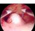 Cirugía endoscópica del mioma uterino